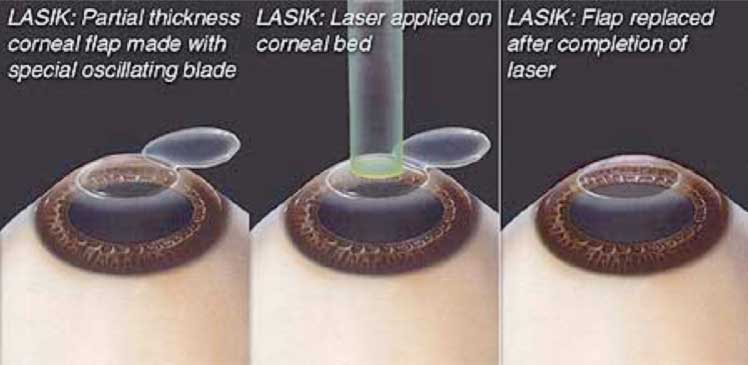 Is Lasik surgery safe?