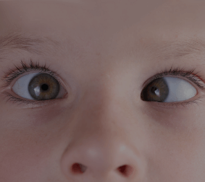STRABISMUS04