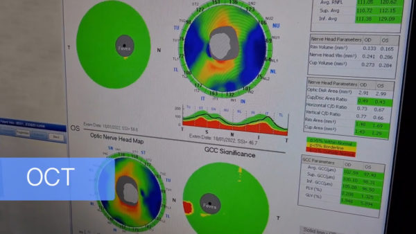 Evaluation-of-optic-nerve-damage