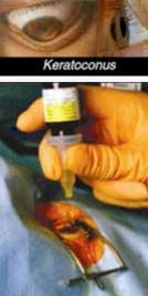 Keratoconus