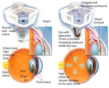 difference between Open angle and Closed angle glaucoma