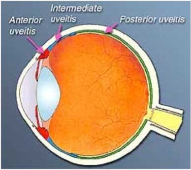 _	Are-There-Different-Kinds-Of-Uveitis-