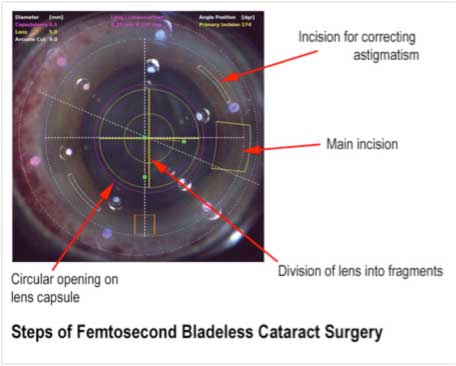Femtosecond bladeless cataract surgery