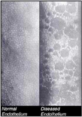 Phaco Cataract Surgery Phaco Cataract Surgery