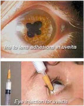 How-Is-Uveitis-Treated-