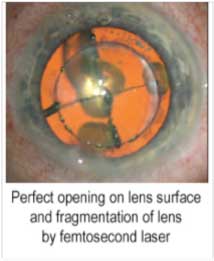 How-is-femtosecond-bladeless-cataract-surgery-different-from-conventional-phacoemulsification-surgery-