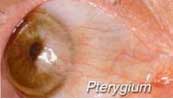 _	Pterygium