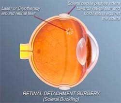 Treating of Retinal Detachment