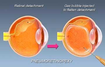 Pneumo-retinopexy