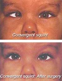 Convergent Squint - After and Before Surgery by Shroff Eye Centre