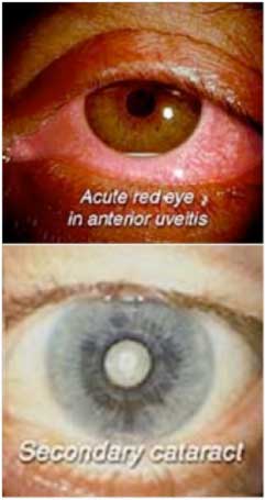 What-Are-The-Symptoms-Of-Uveitis-