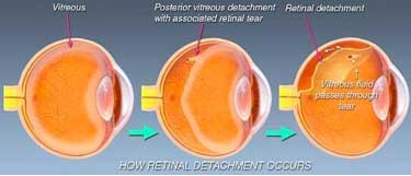 What causes retinal detachment?