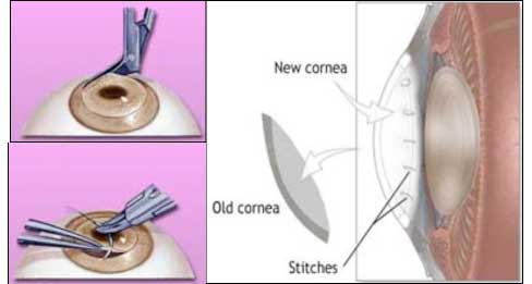 What is Corneal Transplantation?