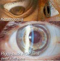 What-is-KERATOCONUS--How-can-contact-lenses-help-