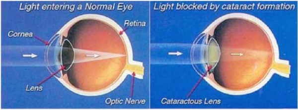 What is Cataract Shroff Eye