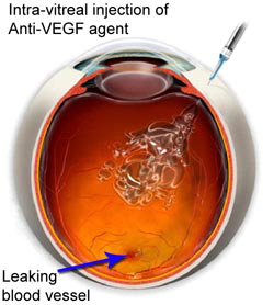 Age-Related Macular Degeneration