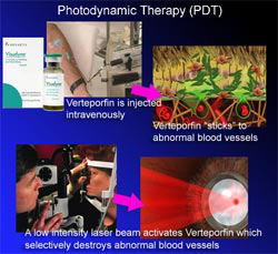 Photodynamic Therapy - Shroff Eye Centre