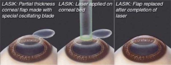 lasik eye surgery cost, lasik eye surgery