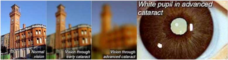 Could I have cataract? What are the symptoms of a developing cataract?