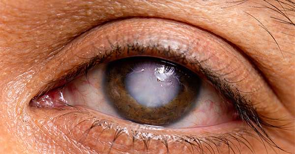 Glaucoma (Kala Motia): Symptoms, Types, Diagnosis & Treatment