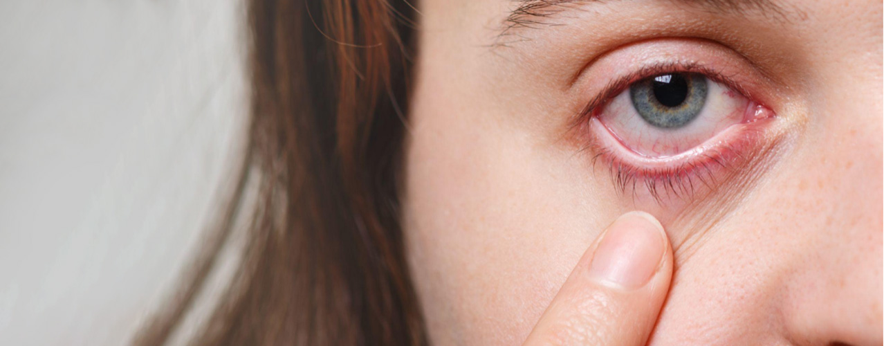 What is pink eye?