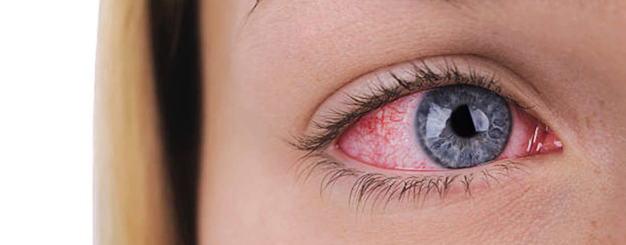 What Do You Need to Know About Eye Redness?