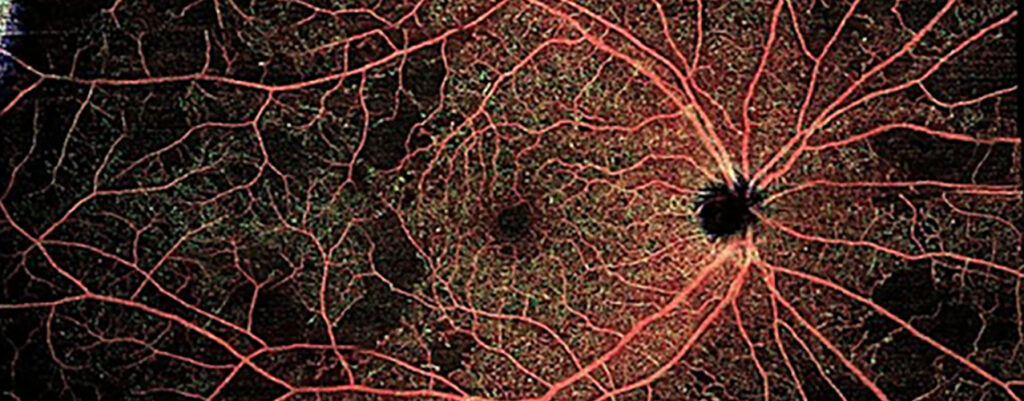 Dry Age-Related Macular Degeneration