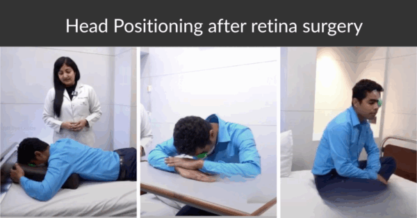 Why is proper head positioning crucial after your retina surgery?