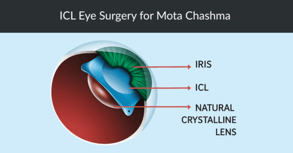 ICL Eye Surgery for Mota Chashma Removal – See the World Clearly Again