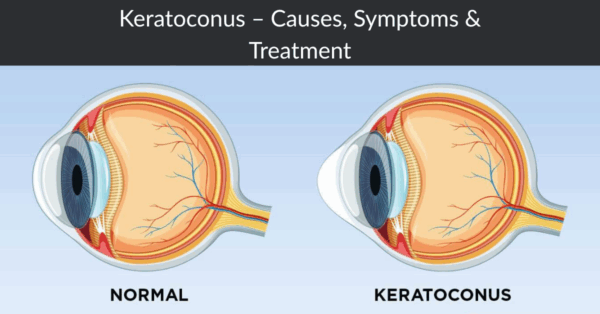 Keratoconus – Causes, Symptoms & Treatment at Shroff Eye Centre