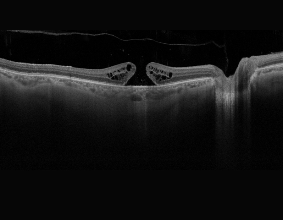 OCT RE full thickness macular hole