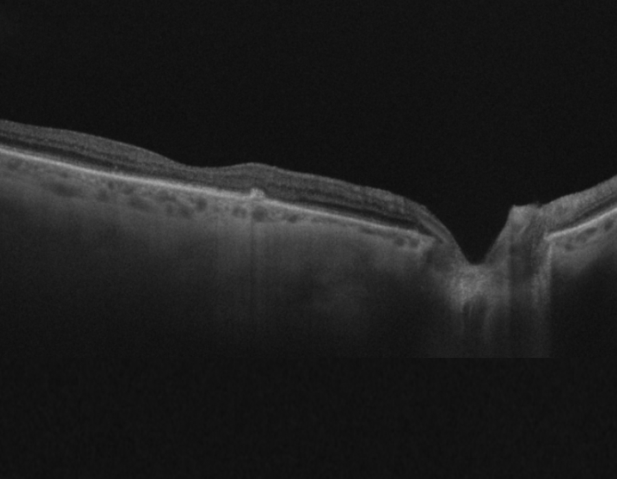 OCT image of retina of right eye with AMD after AntiVEGF injection