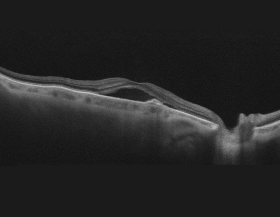 OCT image of retina of right eye with AMD before treatment