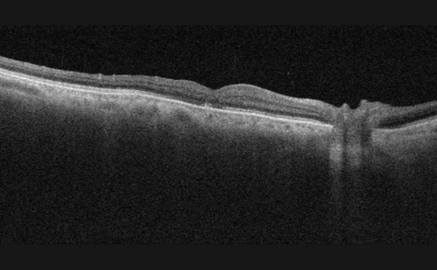OCT macular hole after vitroretina surgery