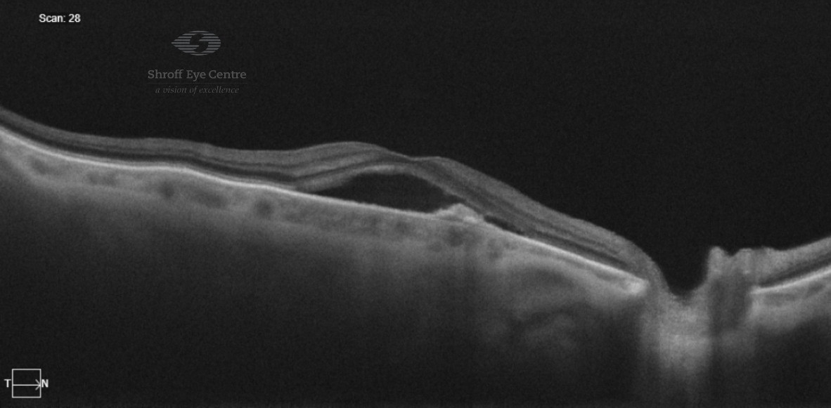 AMD Treatment in Delhi NCR | Macular Degeneration Specialists - Shroff Eye
