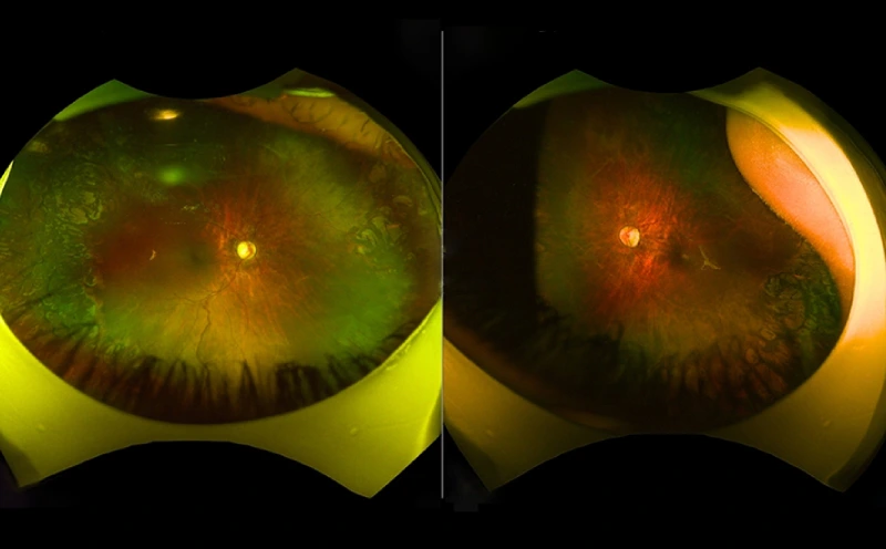 Retinopathy of Prematurity (ROP)