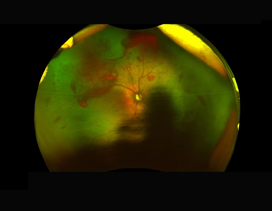 retina before treatment of ROP