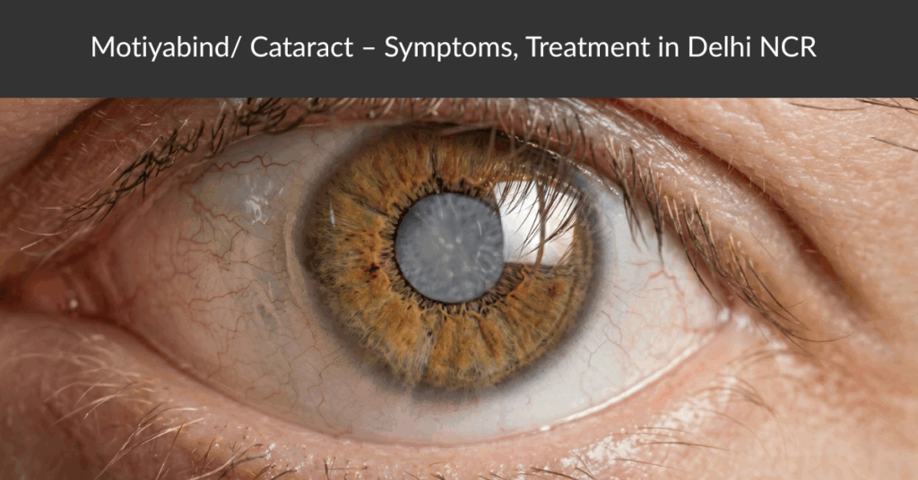 Motiyabind/Cataract - Symptoms, Treatment in Delhi NCR