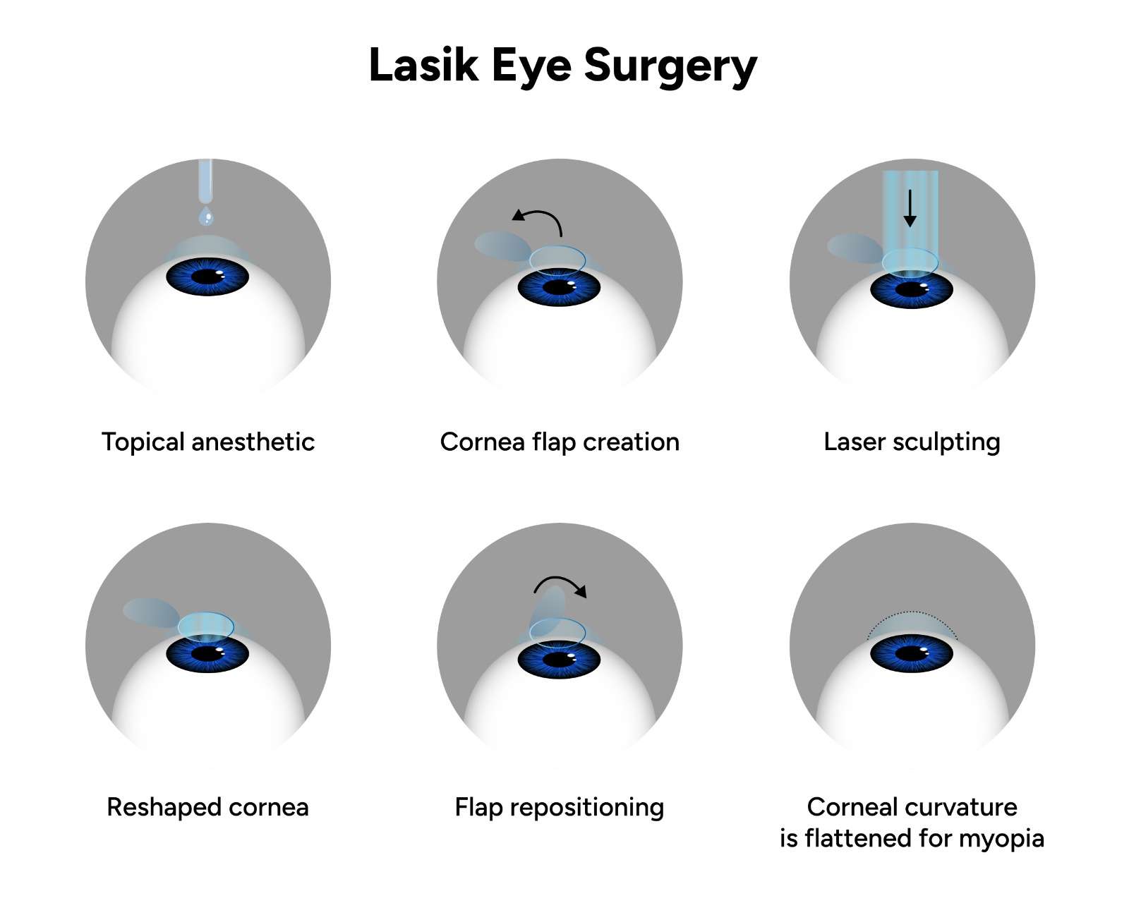  Lasik Eye Surgery